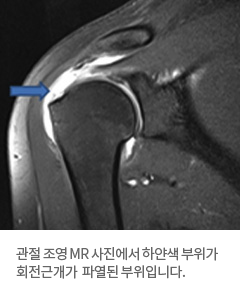 사진:관절 조영 MR 사진에서 하얀색 부위가 회전근개가  파열된 부위입니다.