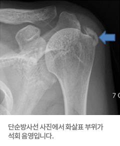 사진:단순방사선 사진에서 화살표 부위가 석회 음영입니다.