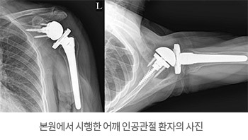 본원에서 시행한 어깨 인공관절 환자의 사진