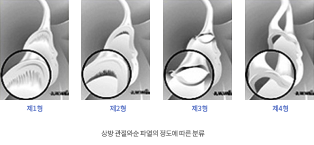 상방 관절와순 파열의 정도에 따른 분류