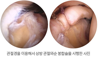 관절경을 이용해서 상방 관절와순 봉합술을 시행한 사진