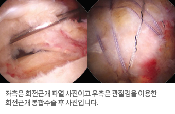 사진:좌측은 회전근개 파열 사진이고 우측은 관절경을 이용한 회전근개 봉합수술 후 사진입니다.