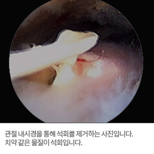 사진:관절내시경을 통해 석회를 제거하는 사진입니다. 치약 같은 물질이 석회입니다.
