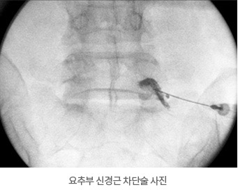 요추부 신경근 차단술 사진