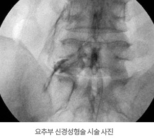 요추부 신경성형술 시술 사진