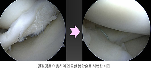 관절경을 이용하여 봉합술 시행한 내시경 사진