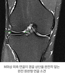 MRI상 외측 연골이 경골 상단을 완전히 덮는 완전 원판형 연골 소견