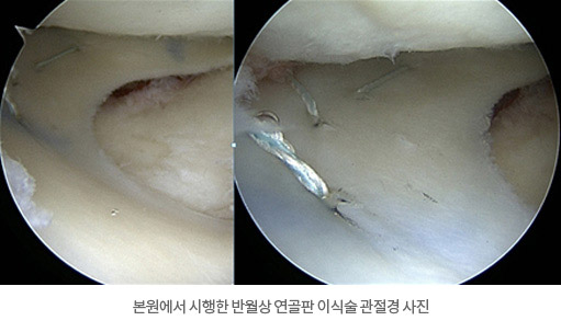 본원에서 시행한 반월상 연골판 이식술 관절경 사진
