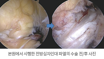 본원에서 시행한 전방십자인대 파열의 수술 전/후 사진