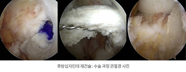 후방십자인대 재건술 : 수술 과정 관절경 사진