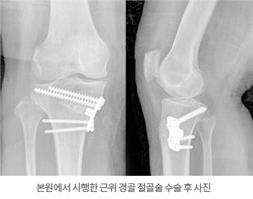 본원에서 시행한 근위 경골 절골술 수술 후 사진