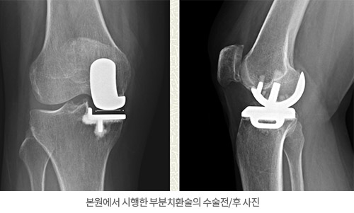 본원에서 시행한 부분치환술의 수술전/후 사진