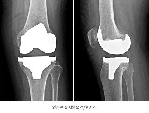 인공 관절 치환술 전/후 사진