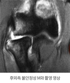 후외측 불안정성 MRI 촬영 영상