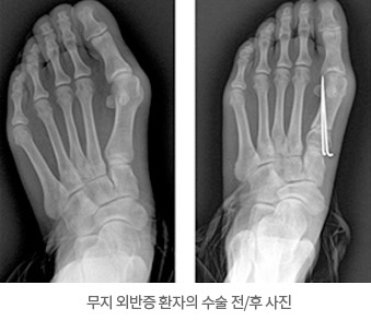 무지 외반증 환자의 수술 전/후 사진