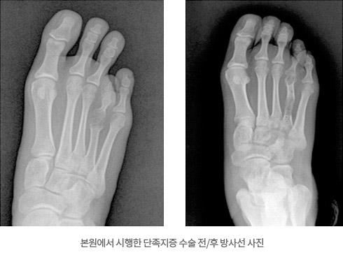 본원에서 시행한 단족지증 수술 전/후 방사선 사진