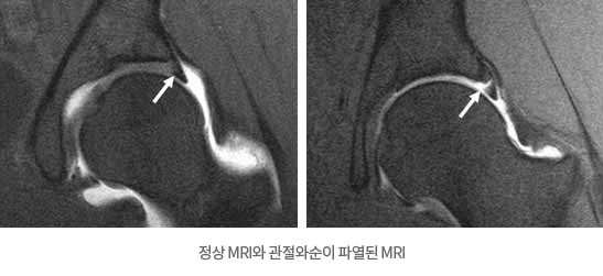 정상 MRI와 관절와순이 파열된 MRI