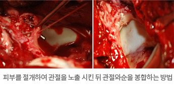 파열된 관절와순을 내시경으로 확인하는 사진과 파열된 관절와순을 내시경으로 봉합한 사진