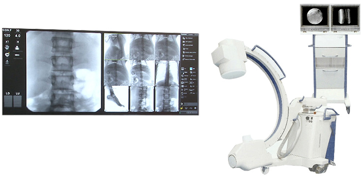 이동형 X-선 투시 촬영장치 C-Arm 사진